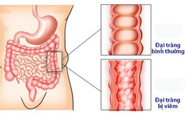 Viêm đại tràng co thắt mạn tính