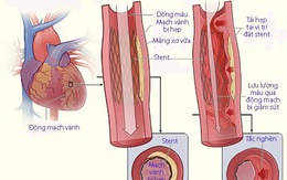 Tái hẹp sau nong mạch và đặt stent