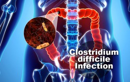 Nhiễm Clostridium Difficile