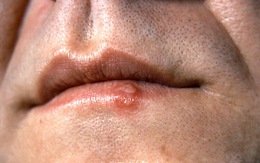 Herpes môi (mụn rộp môi)