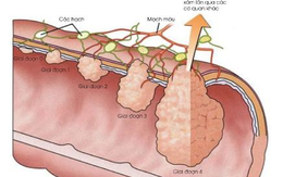Điều trị và theo dõi ung thư đại trực tràng tránh tái phát