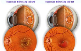 Những hiểu lầm về bệnh thoái hóa điểm vàng thể ướt