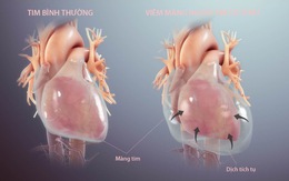 Bệnh viêm màng ngoài tim co thắt có thể dẫn tới suy tim