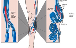 Nguyên nhân của suy giãn tĩnh mạch chân và cách chữa