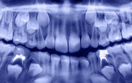 Nhổ bỏ 526 chiếc răng trong miệng bé 7 tuổi