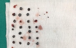 Lấy 39 viên đạn hoa cải nằm 7 tháng trên vùng mặt bệnh nhân