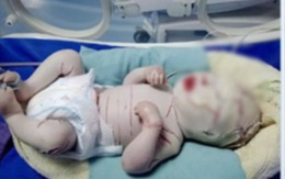 Thêm 1 bé sơ sinh mắc bệnh hiếm, toàn thân bọc vảy trắng nhiều vết nứt