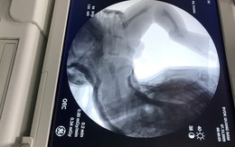 Bé trai sơ sinh ở Quảng Nam bị gãy xương đùi khi sinh mổ