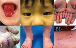Trẻ nhiễm COVID-19 mắc hội chứng lạ giống Kawasaki: làm sao phân biệt hai bệnh?