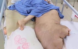Phẫu thuật 'giải cứu' chân trái khổng lồ, nặng 42kg cho cô gái 25 tuổi