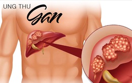 Fucoidan mang đến hi vọng cho người ung thư gan