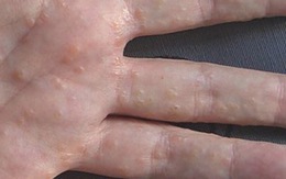 Lạm dụng nước rửa tay sát khuẩn có thể gây bệnh chàm tay