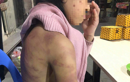 Hà Nội chỉ đạo xử lý vụ bé gái 12 tuổi nghi bị bạo hành, xâm hại