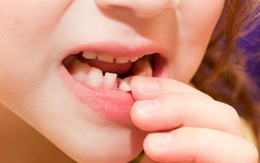 Bé gái 8 tuổi bị răng sữa rơi vào phổi khi tự nhổ răng tại nhà
