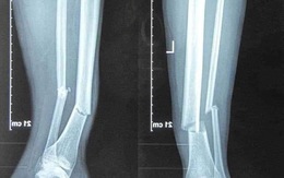 Phim chụp X-quang gãy chân gây sốc lan truyền trên mạng không phải của Hùng Dũng
