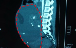 Cắt bỏ khối 'bướu quái buồng trứng' nặng 8kg cho cô gái trẻ 27 tuổi