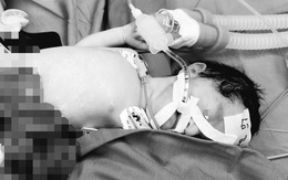 Cứu sống bé gái sơ sinh có nội tạng nằm ngoài ổ bụng