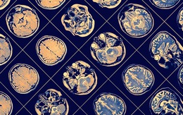 Phần mềm AI của IBM giúp chẩn đoán diễn tiến bệnh Parkinson
