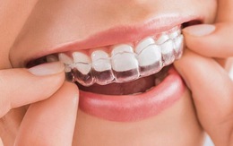 Phương pháp niềng răng trong suốt thu hút giới trẻ