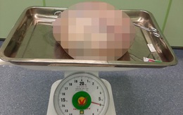 Mang khối u buồng trứng 6kg, người phụ nữ 66 tuổi nghĩ… mỡ bụng