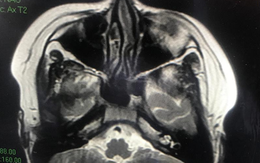 Sau khi khỏi COVID-19 nặng, bé trai bị tổn thương não vì mắc hội chứng viêm đa hệ thống