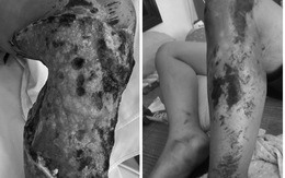 Thiếu niên 13 tuổi chân hoại tử, chảy mủ vì đắp lá thuốc chữa bầm tím