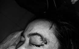 Thêm 1 tai nạn chó cắn: Người phụ nữ bị chó cắn rách kết mạc mắt, đứt lệ quản