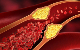 Giảm cholesterol tránh xơ vữa động mạch không cần dùng thuốc, cách nào?