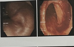 Trẻ em tiêu ra máu, cảnh báo polyp đại tràng