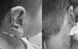 Bé trai 8 tuổi bị chó Phú Quốc vồ, cào mất một phần vành tai
