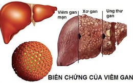 Làm gì để viêm gan B không biến chứng ung thư gan?