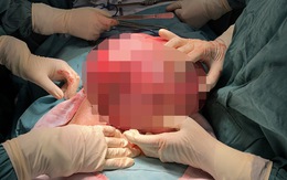 Bệnh nhân 58 tuổi mang u xơ tử cung 7,3kg