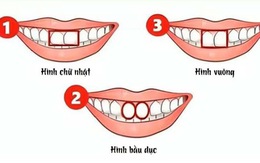 Hình dạng răng cửa nói gì về bạn?