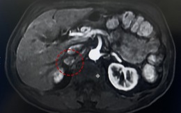 Phát hiện khối u tuyến thượng thận nhờ chụp cộng hưởng từ MRI
