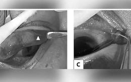 Bác sĩ phát hiện giun sống dưới mí mắt của một phụ nữ