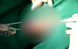 Lấy dương vật giả dài 20cm ra khỏi trực tràng của nam bệnh nhân ở Cà Mau