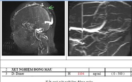 Đau đầu 4 ngày, đến viện mới phát hiện mắc thể đột quỵ não đặc biệt