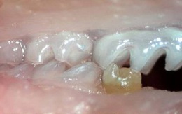 Tạo ra răng từ tế bào gốc