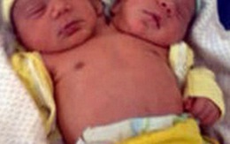 Cặp sinh đôi 2 đầu một cơ thể tại Brazil