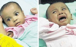Malaysia tách cặp song sinh dính liền 15 tháng