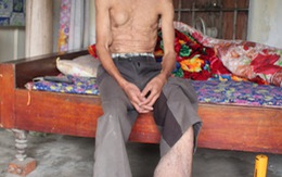 Người đàn ông mang khối u nặng 7kg ở chân