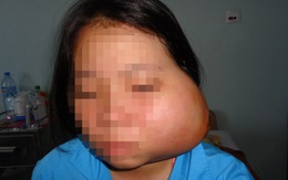 Phẫu thuật bướu gây biến dạng mặt bé gái 15 tuổi