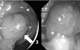 ​Điều trị ung thư đại tràng bằng nội soi