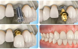 ​Cấy ghép Implant – Phương pháp trồng răng giả hiện đại