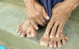 Người đàn ông có 14 ngón chân