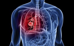 ​Có thể phát hiện ung thư phổi bằng cách thử máu