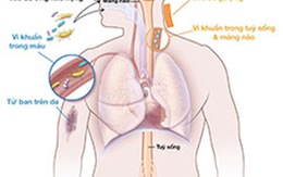 ​Phát hiện sớm và phòng ngừa nhiễm não mô cầu ở trẻ em