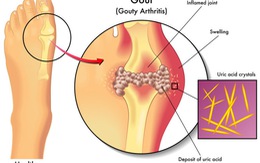 Chế độ ăn giúp giảm acid uric trong máu