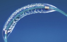 ​Khuyến cáo mới sau phẫu thuật đặt ống stent nong mạch vành