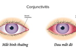 ​Dịch đau mắt đỏ có nguy cơ bùng phát trở lại
